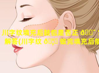 川字纹填充后鼓包是否正 🐯 常解答(川字纹 🦈 做完填充后能保持多久)